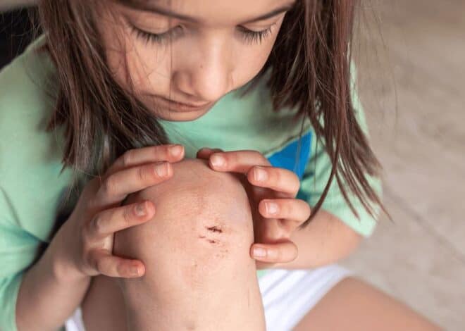 Quick Home remedies for Minor Cuts and burns